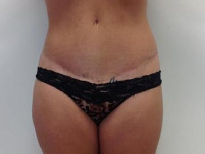 Tummy Tuck Before & After Gallery - Patient 120905340 - Image 2