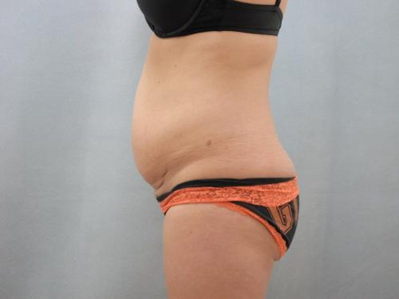 Tummy Tuck Gallery - Patient 120905340 - Image 5
