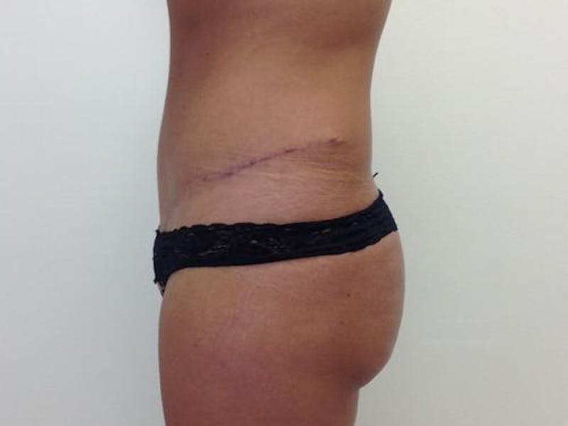 Tummy Tuck Before & After Gallery - Patient 120905340 - Image 6