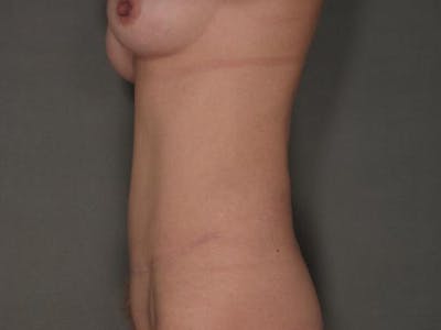 腹部整形手术前后画廊-病人120905343 -图2