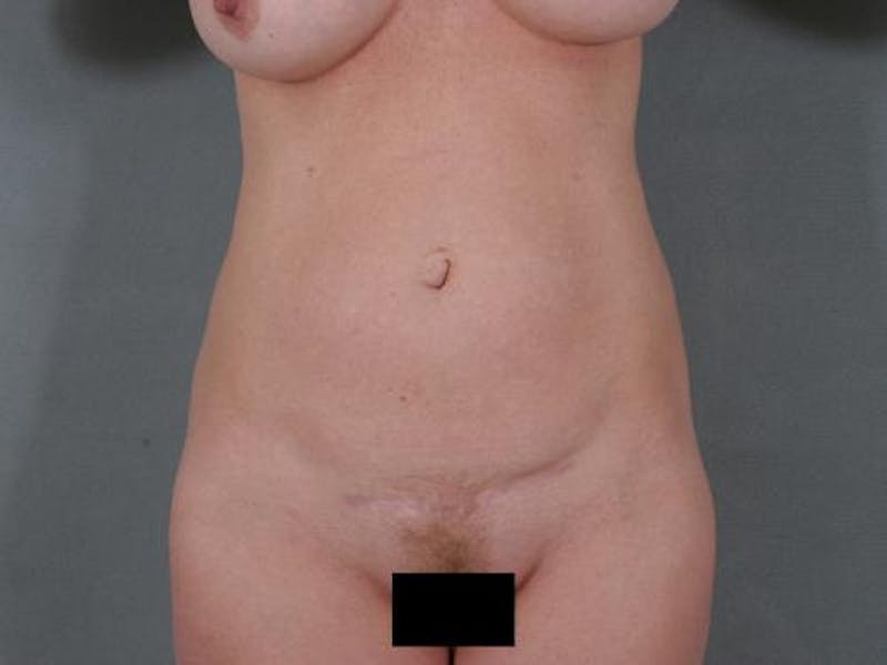 Tummy Tuck Before & After Gallery - Patient 120905343 - Image 3