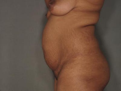 腹部整形手术前后图库-患者120905353 -图1