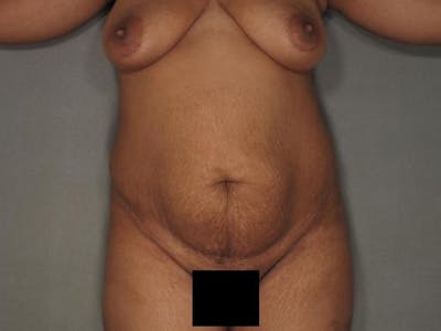 Tummy Tuck Before & After Gallery - Patient 120905353 - Image 1