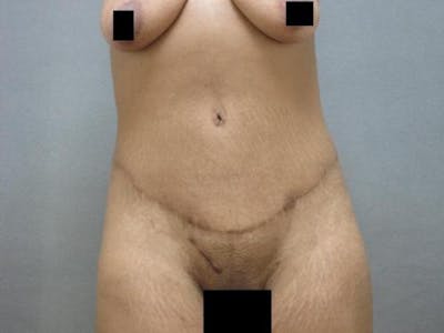 Tummy Tuck Before & After Gallery - Patient 120905353 - Image 2