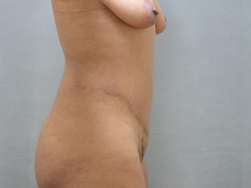 Tummy Tuck Before & After Gallery - Patient 120905353 - Image 6