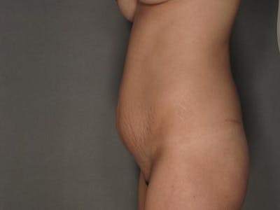 Tummy Tuck Gallery - Patient 120905355 - Image 1