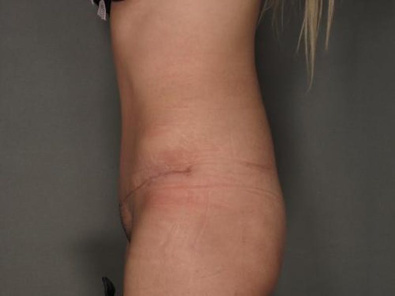 Tummy Tuck Before & After Gallery - Patient 120905355 - Image 4