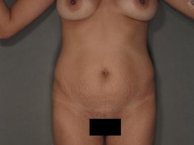 Tummy Tuck Before & After Gallery - Patient 120905355 - Image 1