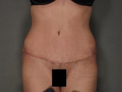 Tummy Tuck Before & After Gallery - Patient 120905355 - Image 2