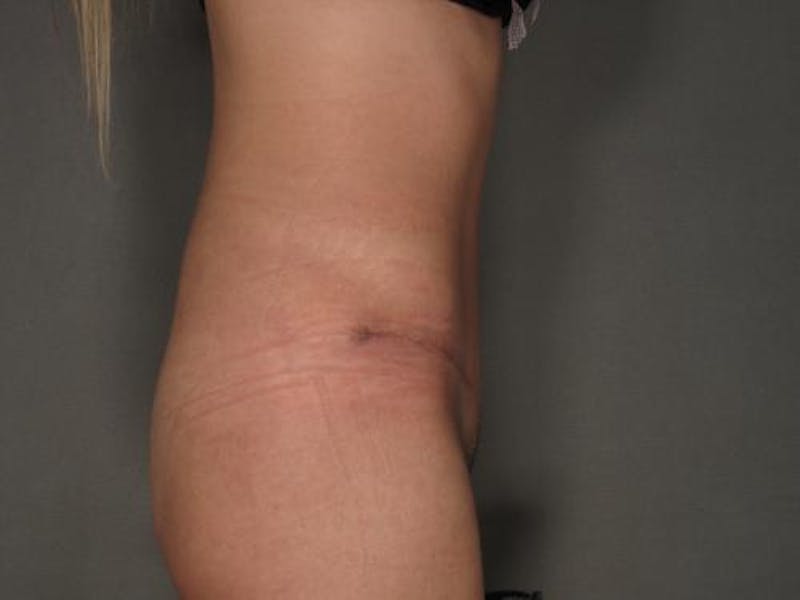 Tummy Tuck Before & After Gallery - Patient 120905355 - Image 6