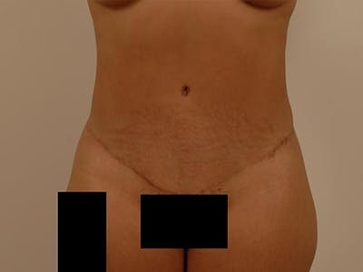 腹部整形手术前后画廊-病人120905361 -图2