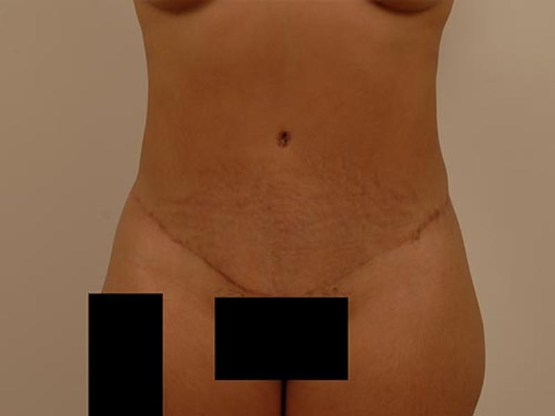 Tummy Tuck Before & After Gallery - Patient 120905361 - Image 2