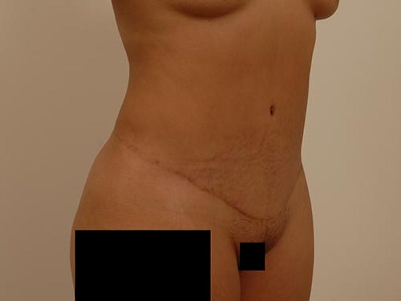 Tummy Tuck Before & After Gallery - Patient 120905361 - Image 4