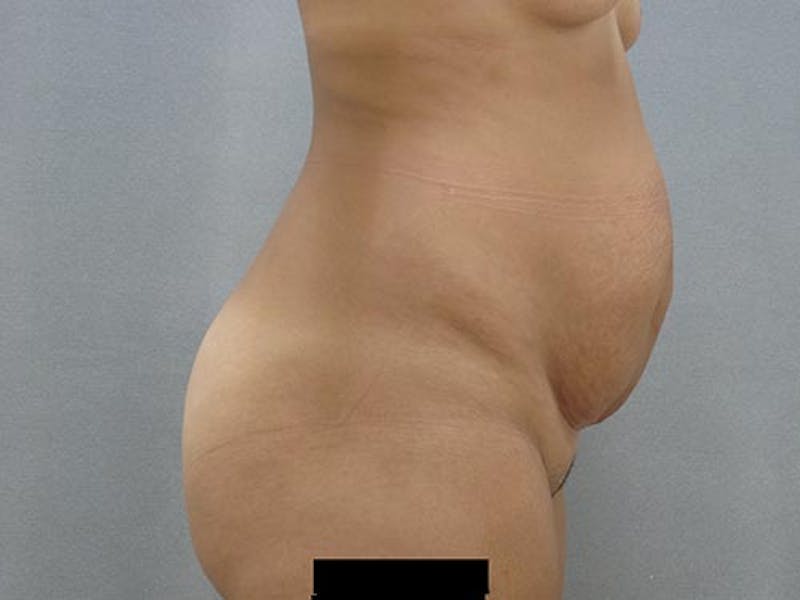 Tummy Tuck Before & After Gallery - Patient 120905361 - Image 5