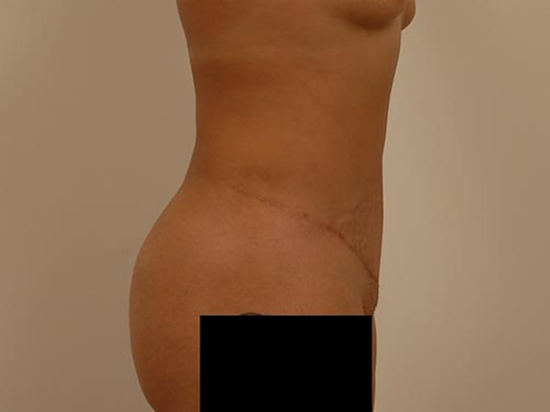 Tummy Tuck Before & After Gallery - Patient 120905361 - Image 6
