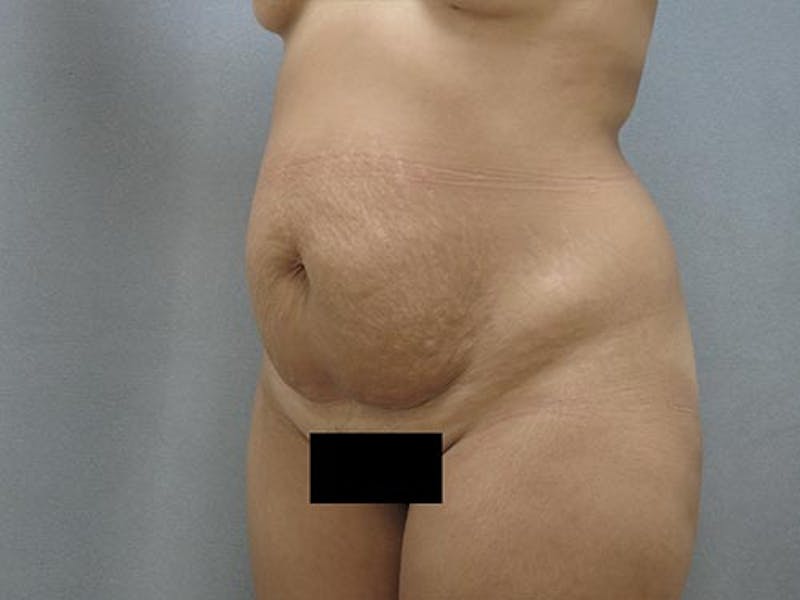 Tummy Tuck Before & After Gallery - Patient 120905361 - Image 7
