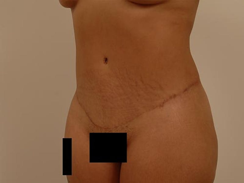 Tummy Tuck Before & After Gallery - Patient 120905361 - Image 8