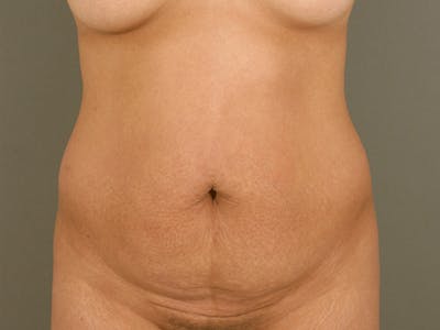 腹部整形手术前后画廊-病人120905363 -图片1