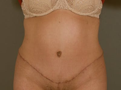 Tummy Tuck Before & After Gallery - Patient 120905363 - Image 2