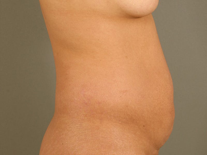 Tummy Tuck Before & After Gallery - Patient 120905363 - Image 5
