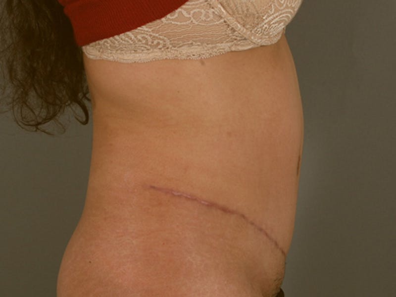 Tummy Tuck Before & After Gallery - Patient 120905363 - Image 6
