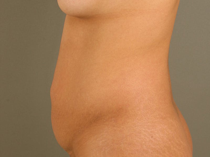 Tummy Tuck Before & After Gallery - Patient 120905363 - Image 9