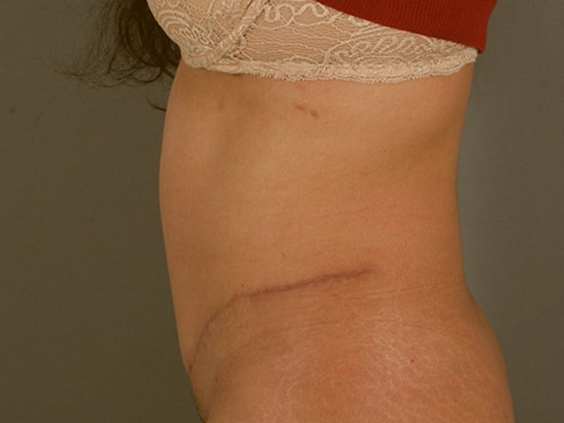 Tummy Tuck Gallery - Patient 120905363 - Image 10