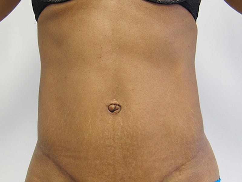 Tummy Tuck Gallery - Patient 120905367 - Image 2