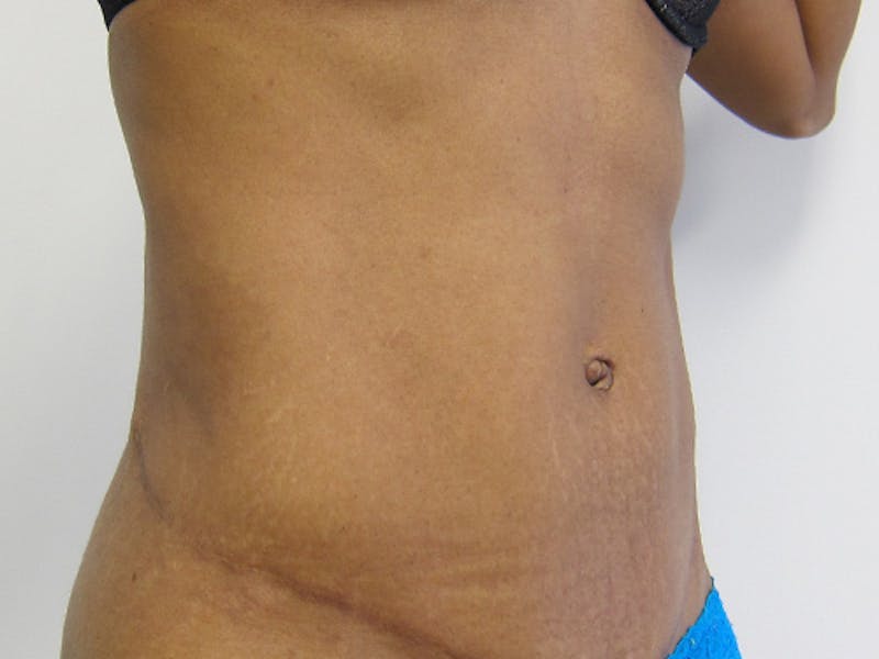 Tummy Tuck Gallery - Patient 120905367 - Image 4