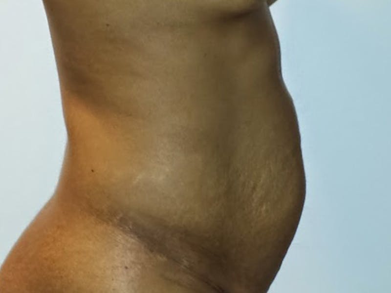 Tummy Tuck Before & After Gallery - Patient 120905367 - Image 5