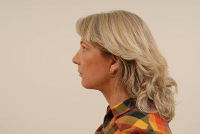 Facelift Before & After Gallery - Patient 120905366 - Image 2