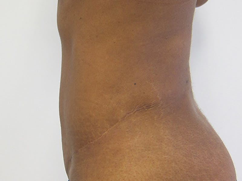 Tummy Tuck Gallery - Patient 120905367 - Image 10