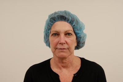 Facelift Before & After Gallery - Patient 120905369 - Image 1