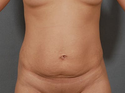 腹部整形手术前后图库-患者120905370 -图1