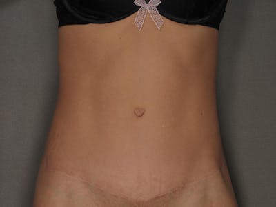 腹部整形手术前后图库-患者120905370 -图2