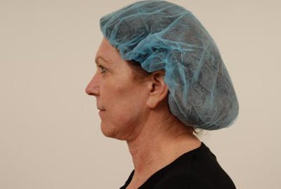 Neck Lift Before & After Gallery - Patient 123930 - Image 1