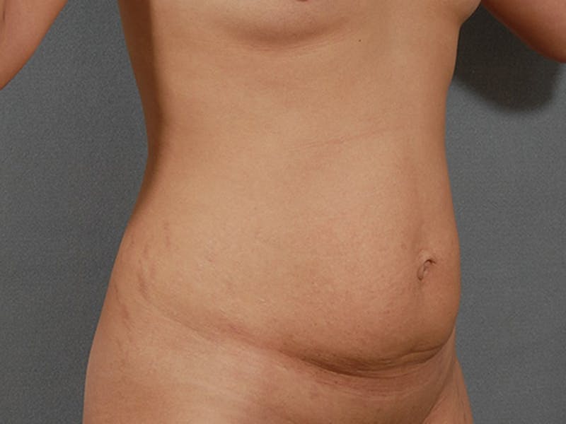 Tummy Tuck Before & After Gallery - Patient 120905370 - Image 3