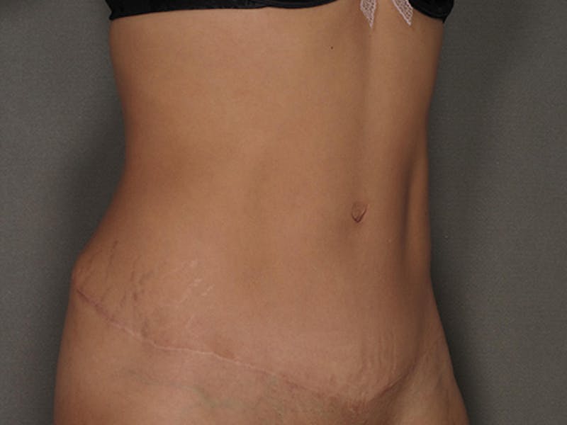 Tummy Tuck Before & After Gallery - Patient 120905370 - Image 4