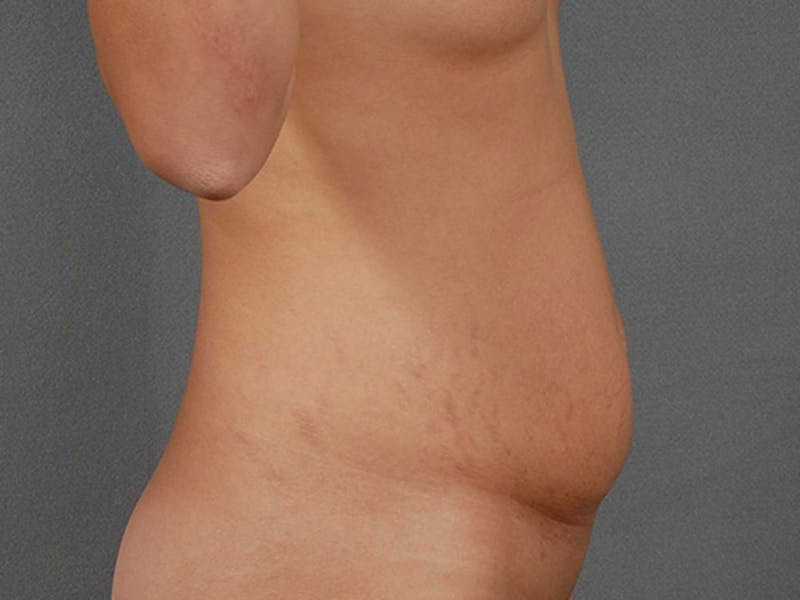 Tummy Tuck Before & After Gallery - Patient 120905370 - Image 5