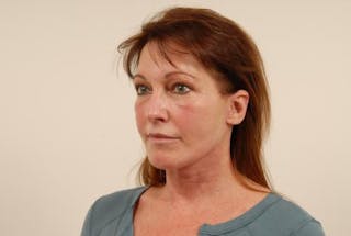 Facelift Before & After Gallery - Patient 120905369 - Image 6