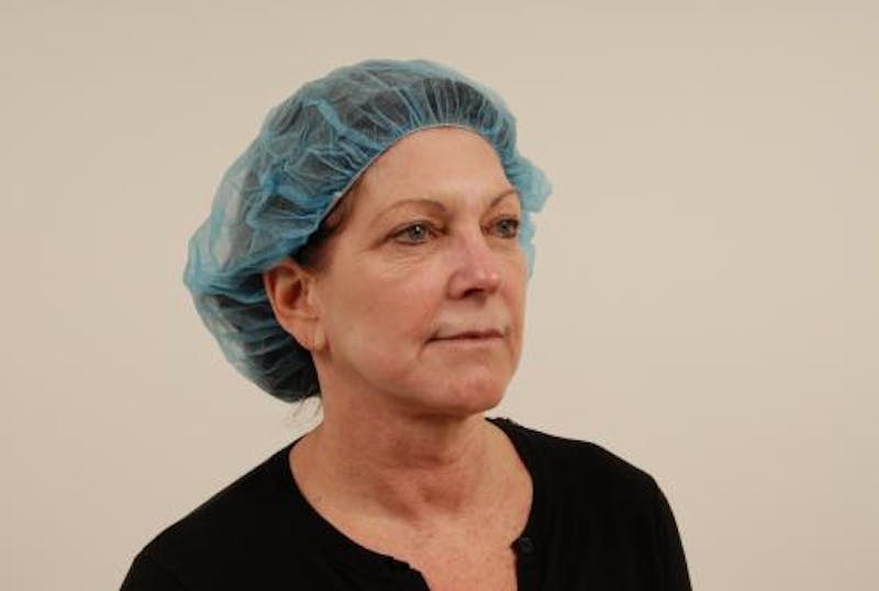 Facelift Before & After Gallery - Patient 120905369 - Image 7