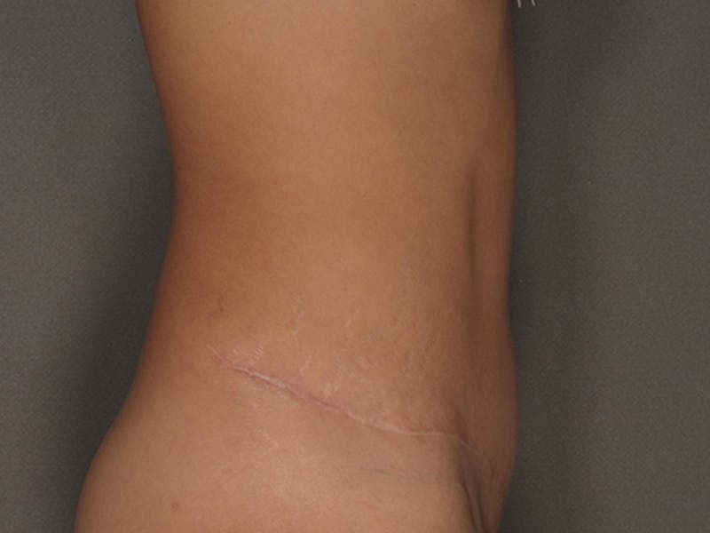 Tummy Tuck Before & After Gallery - Patient 120905370 - Image 6