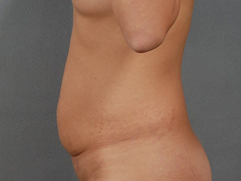 Tummy Tuck Before & After Gallery - Patient 120905370 - Image 7