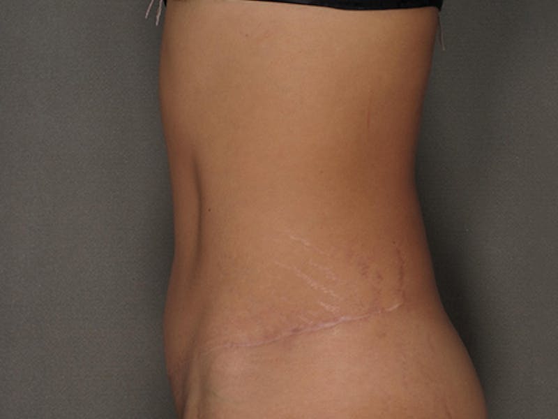 Tummy Tuck Before & After Gallery - Patient 120905370 - Image 8