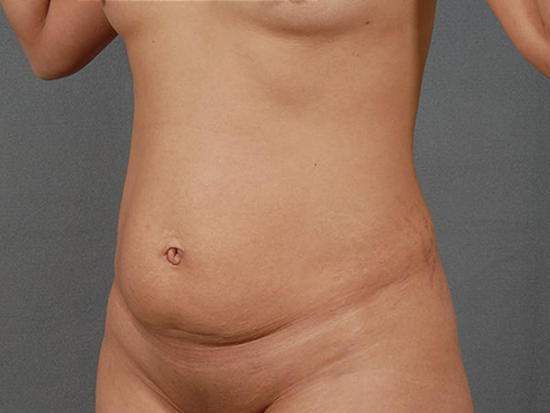 Tummy Tuck Before & After Gallery - Patient 120905370 - Image 9