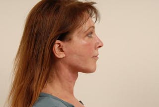 Facelift Before & After Gallery - Patient 120905369 - Image 10
