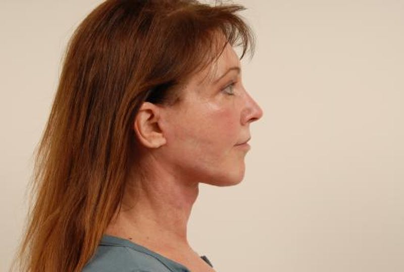 Facelift Before & After Gallery - Patient 120905369 - Image 10