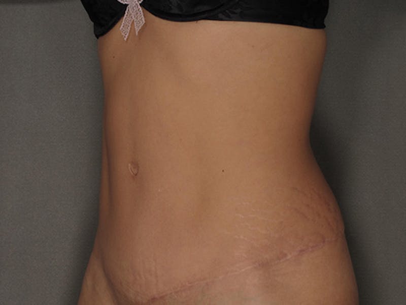 Tummy Tuck Before & After Gallery - Patient 120905370 - Image 10