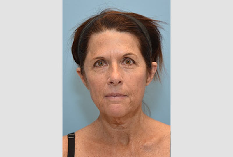 Facelift Before & After Gallery - Patient 120905373 - Image 1