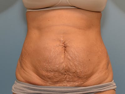 Tummy Tuck Before & After Gallery - Patient 120905372 - Image 1